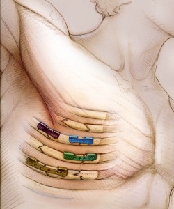 Surgical-Academy-of-Ortho-Surgeons-Flail-Chest