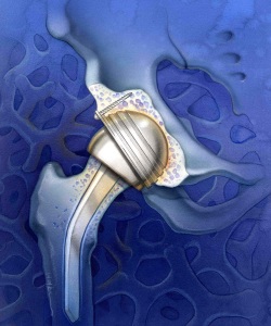 Surgical-Acute-Care-Magazine-Hip-Replacement