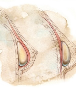 Surgical-Americal-Society-for-Aesthetic-Surgery_-Augment
