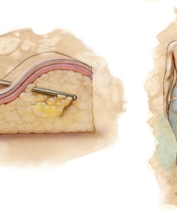 Surgical-American-Society-for-Aesthetic-Plastic-Surgery-Inc._Liposuction