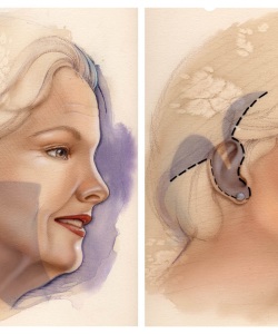 Surgical-American-Society-for-Aesthetic-Plastic-Surgery-Inc._Lower-Face-and-Neck-Lift