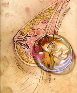 Surgical-Emergency-Medicine-Detecting-Breast-Cancer-After-Augmentation