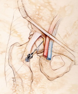 Surgical-Emergency-Medicine-Magazine-Surgical-Injection-Site