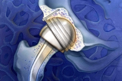 Surgical-Acute-Care-Magazine-Hip-Replacement